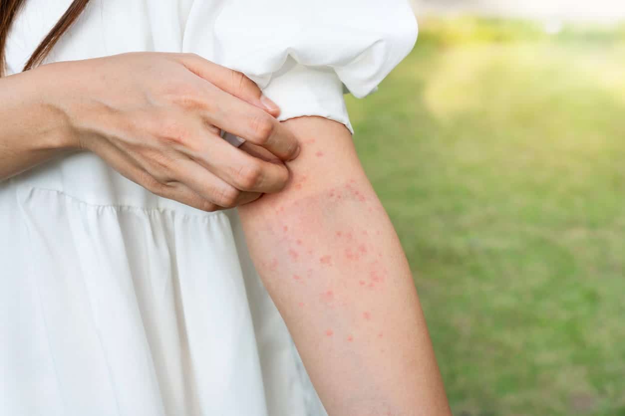 A person itching their arm with red spots, potentially from bug bite allergies, all over it.
