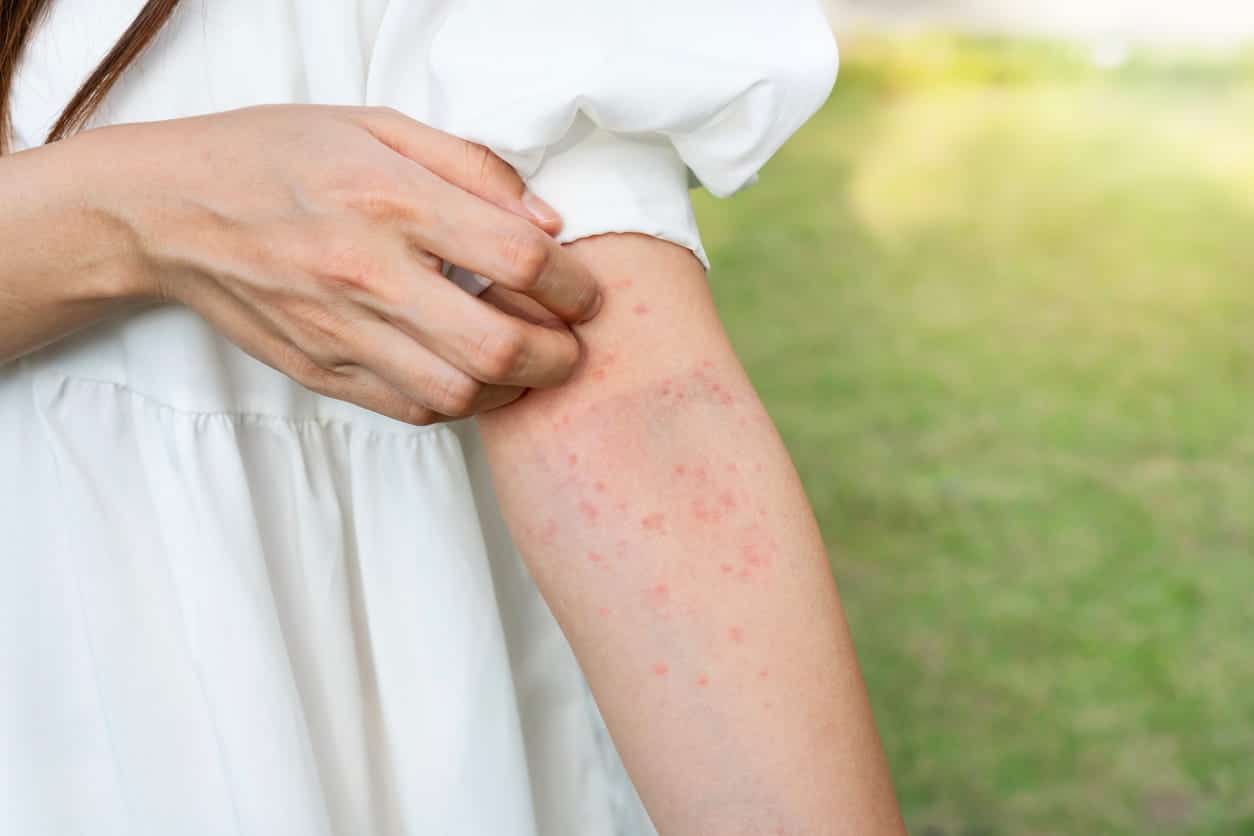 Allergy Rash 101, Understanding Skin Allergies