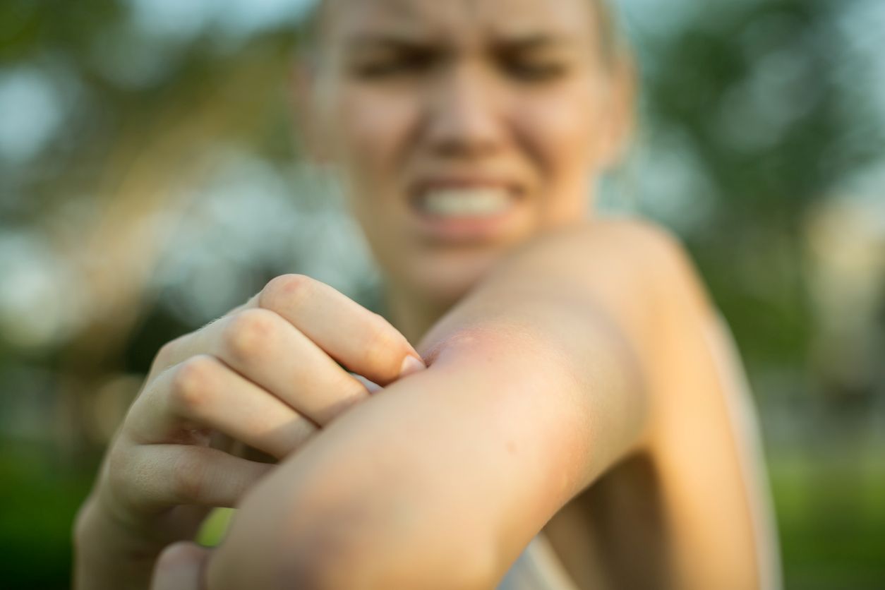 A woman scratching her arm with mosquito bites