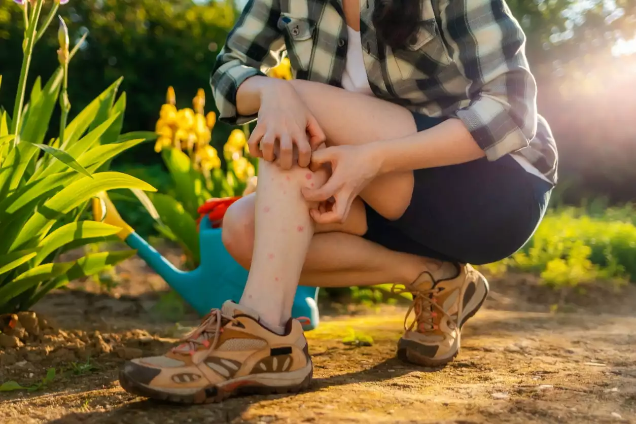 Person scratches her legs, which is itchy from a mosquito bite.